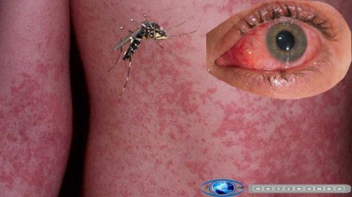 卫生官员:加州确诊6例寨卡病毒感染病例