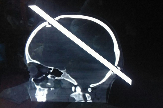 惊险!印度工人遭铁棒穿脑,奇迹般获救生还!(图)