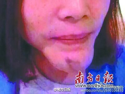 女子乱打"美容针"毁容 下巴长成"后脚跟"(图)