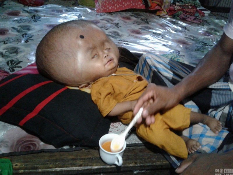 慎入:孟加拉国2岁男孩患脑水肿 头重18斤还在长