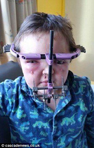 8岁男童患怪病需打碎脸骨再重塑 父母不离不弃