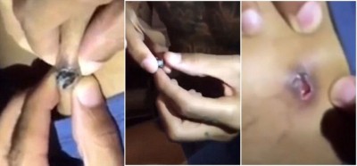 慎入:美汉大腿中枪不求医 自己挤出子弹(组图)