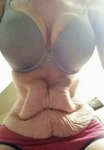 慎入:女子快速减肥153斤成“沙皮狗” 被迫手术