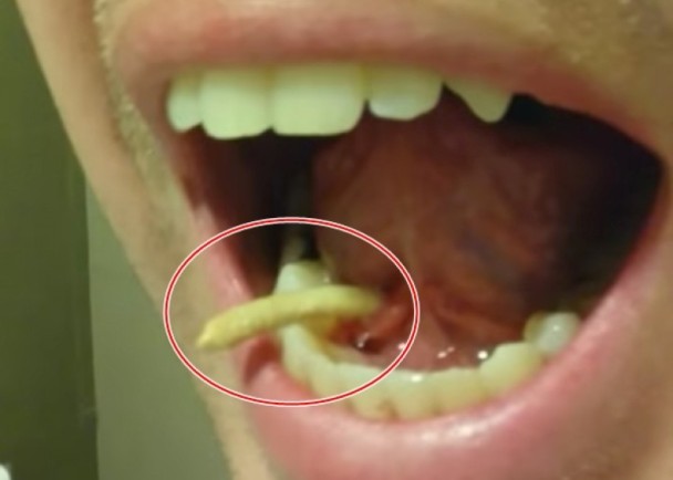 慎入!美国男自拍 用舌头挤出口水腺结石(图/视)