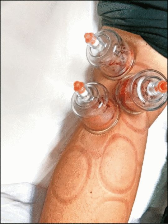 好拼!吴建豪练舞受伤 拔罐放血缓解病痛(图)