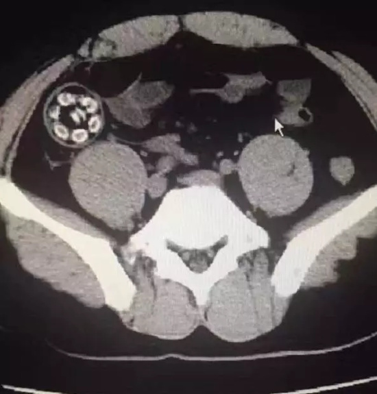 可怕!24岁男子吃杨梅 体内一器官竟破了(图)